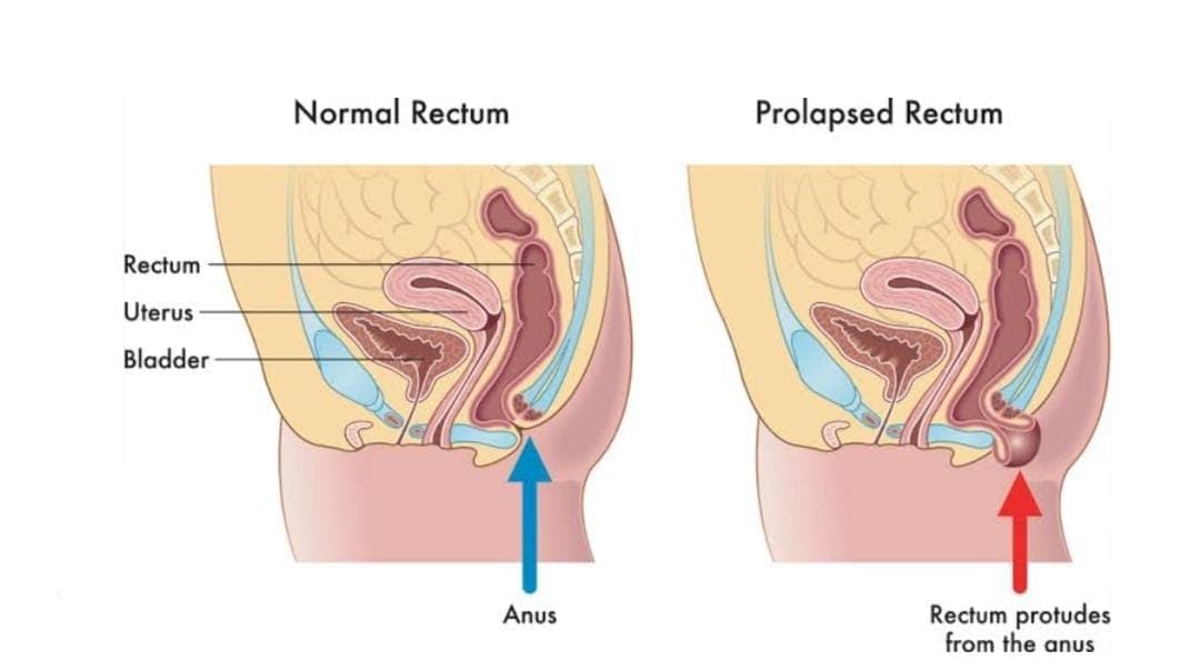 Rectal Prolapse