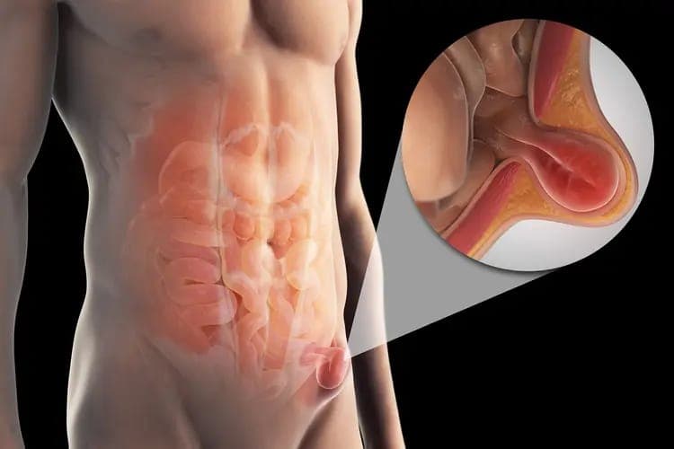 Hernia