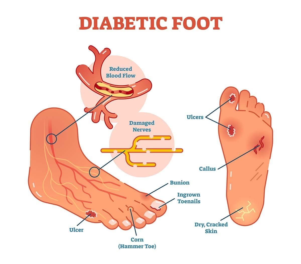 diabetic foot
