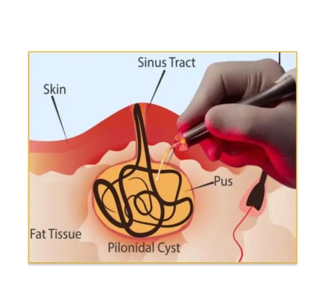 Pilonidal sinus