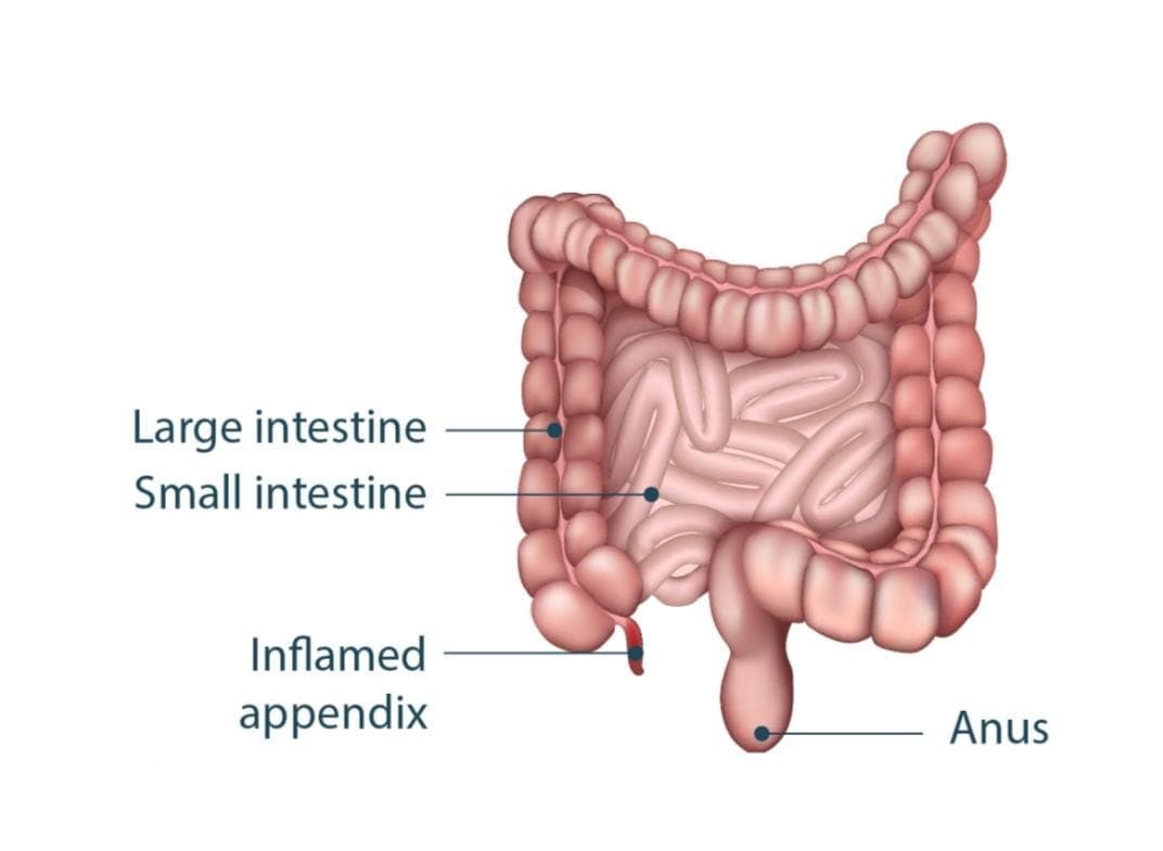 Appendicitis