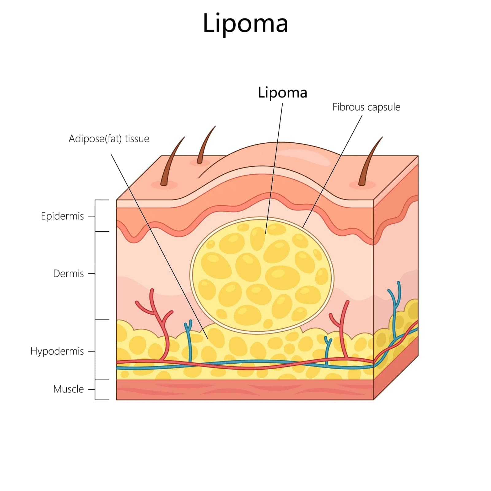 Lipoma