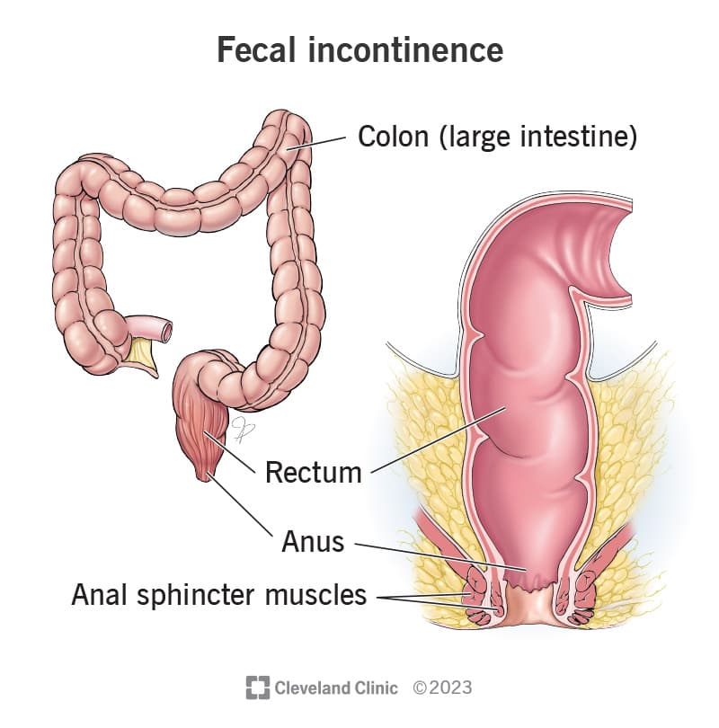 Fecal Incontinence