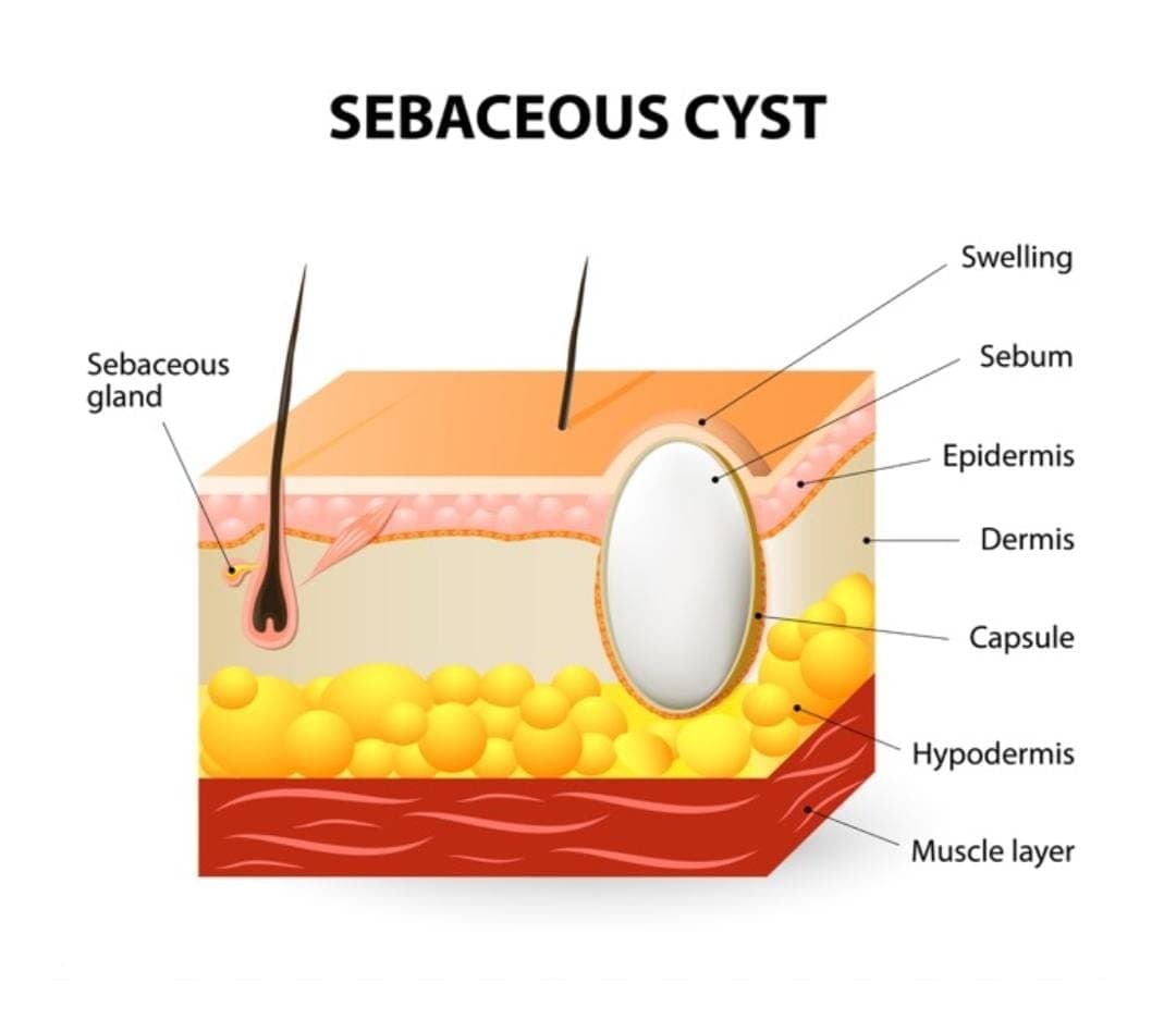 Sebaceous Cyst